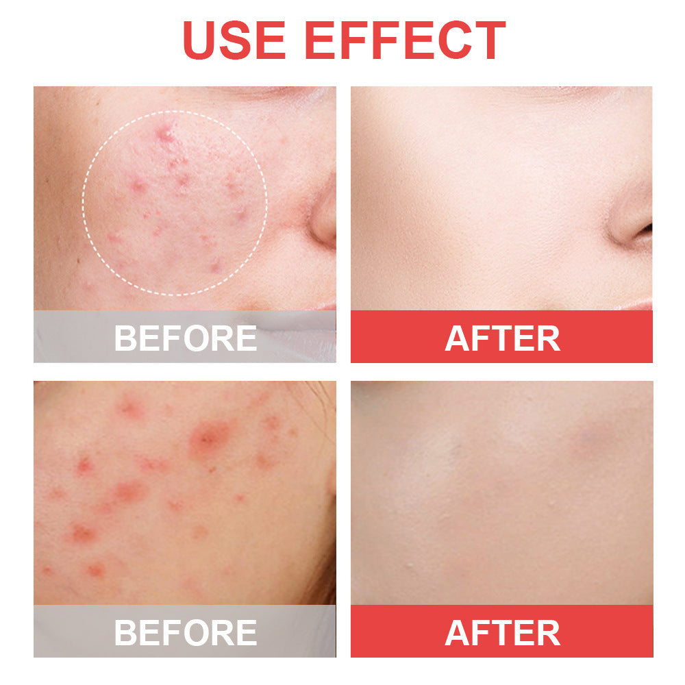 True Hydrocolloid acne patch product image