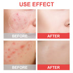 True Hydrocolloid acne patch product image